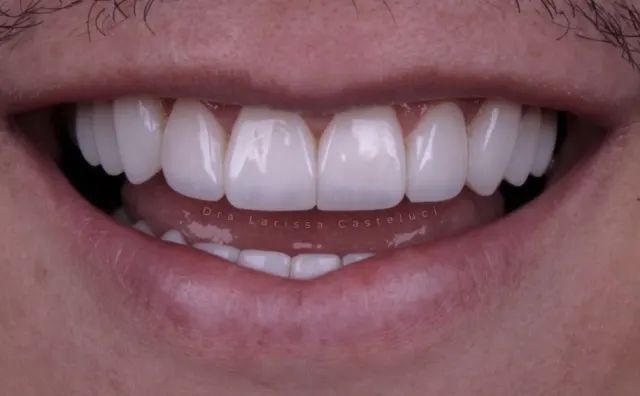 Sorriso depois da transformação 02