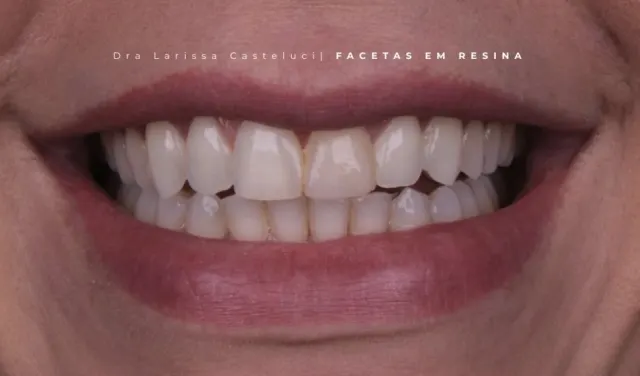 Sorriso antes da transformação 05